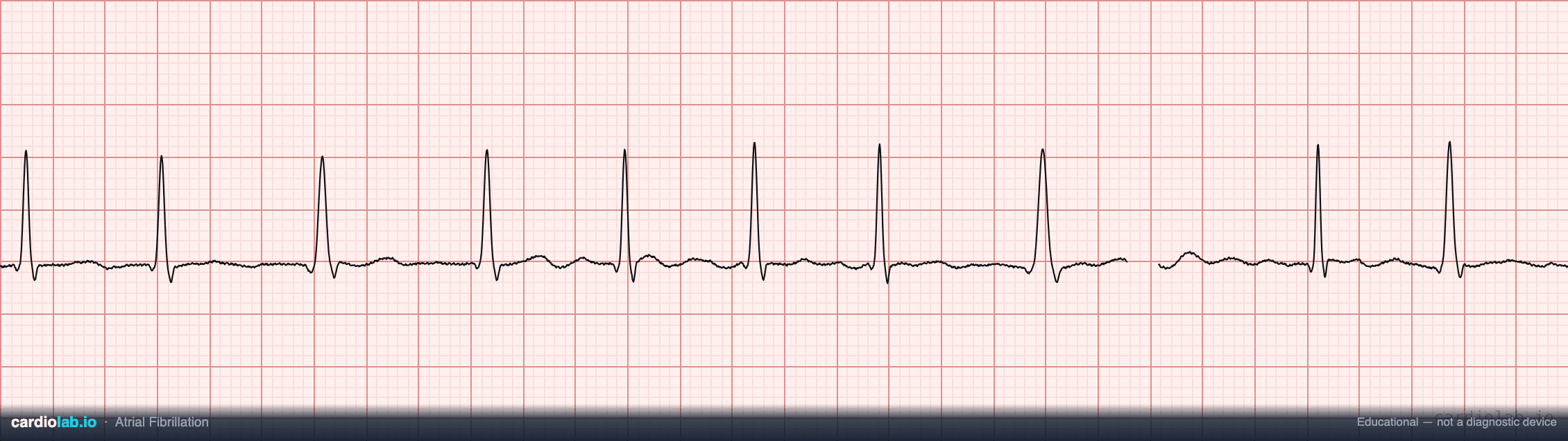 Atrial fibrillation rhythm strip exported from CardioLab: irregularly irregular R–R intervals with no discernible P waves on calibrated ECG paper