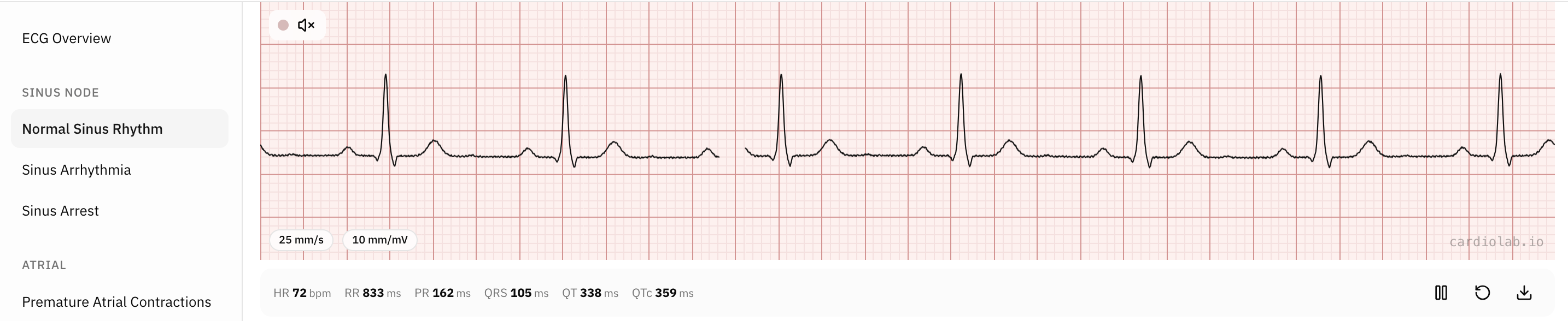 Idioventricular Rhythm — ECG Rhythm | cardiolab