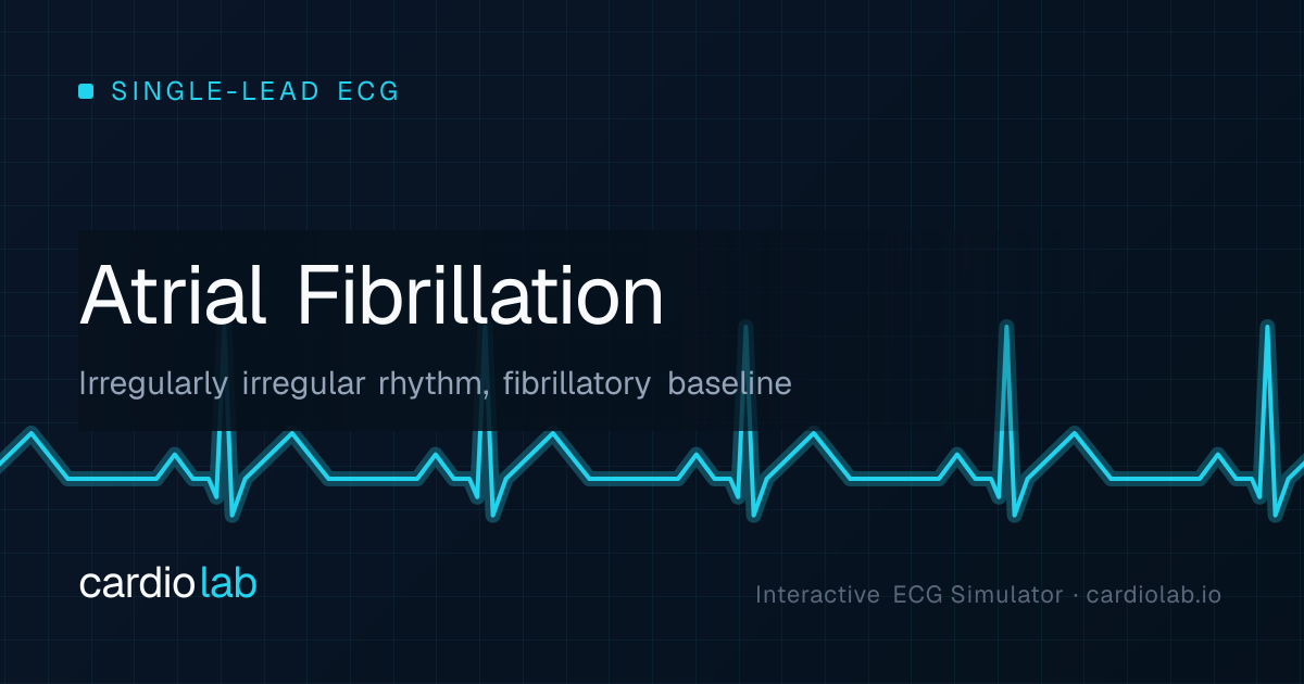 Atrial Fibrillation — ECG on CardioLab